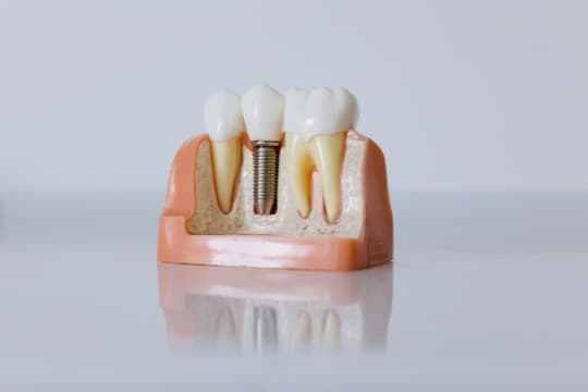 Restorative dental work shown on a model Restorative dental work shown on a model